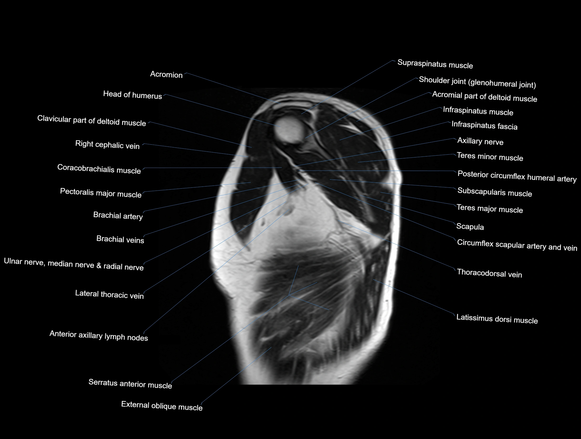 MRI chest (thorax) coronal  cross sectional anatomy 3T radiology  image-img-00001-00003.webp